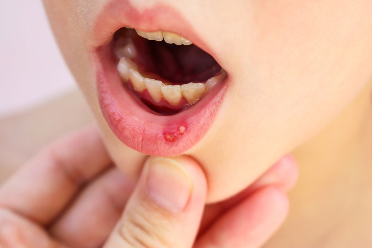Mundfäule bei Kindern: Erkennen, Behandeln, Vorbeugen